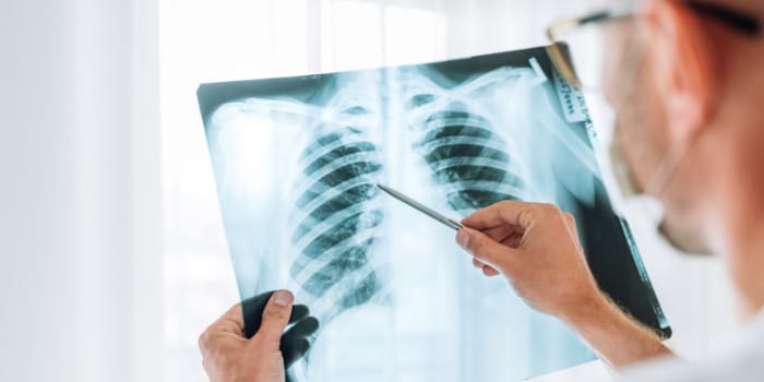 A doctor examining an x-ray photo of lungs.