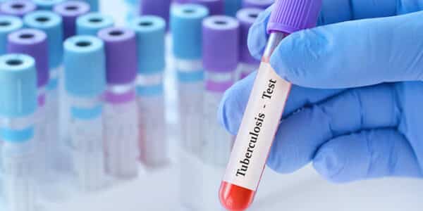 tuberculosis-test-news